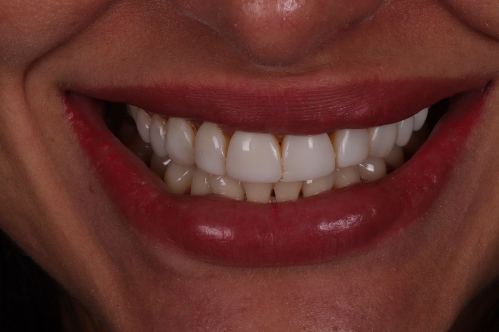 Harmonização do sorriso antes