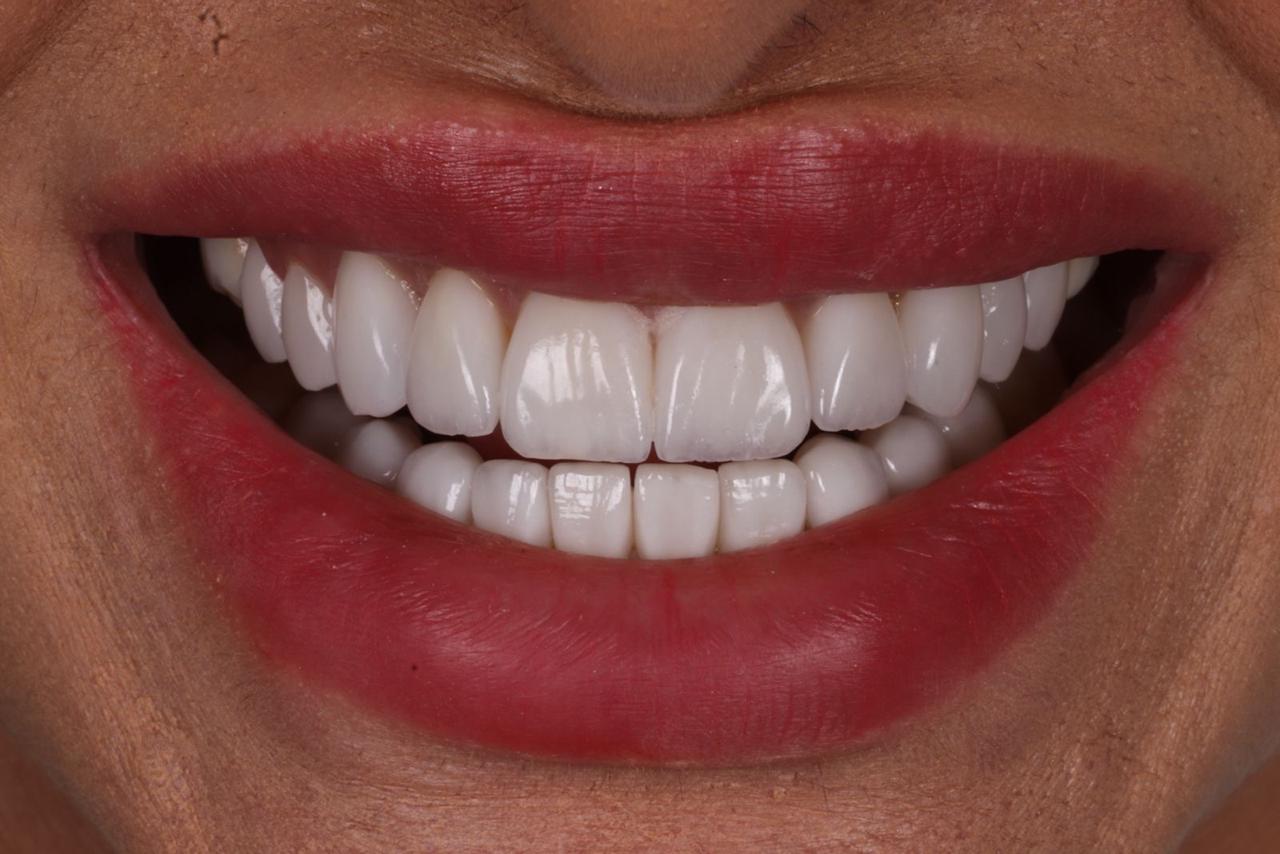 Harmonização do sorriso depois